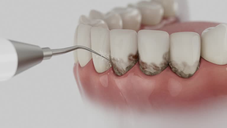 Trusted Wisdom Tooth Removal service in Olympia Heights, FL - Dentist Open Now